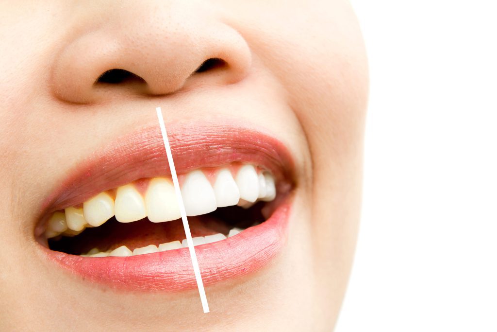 Why Are My Teeth Yellow Despite Brushing?