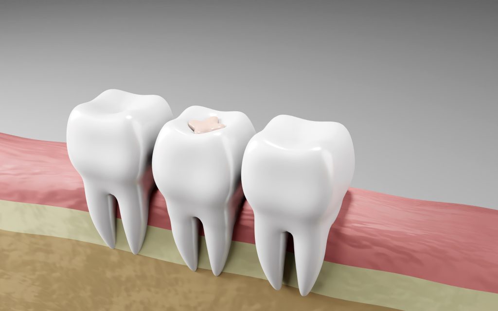 Re-root canal treatment result with dental filling on molar, highlighting restored tooth structure and gum health
